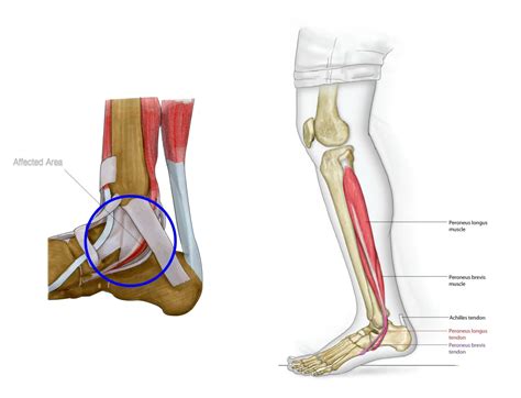 tibial posterior